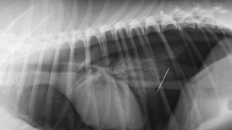 Мужчина 17 лет прожил с иглой в животе