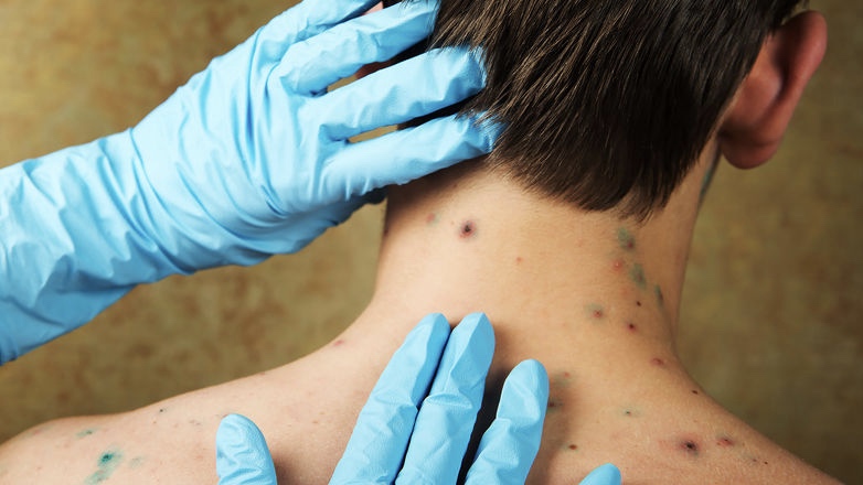 Врач рассказал о связи ветрянки и иммунитета к коронавирусу