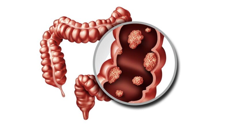 Врачи нашли способ предотвратить рак кишечника