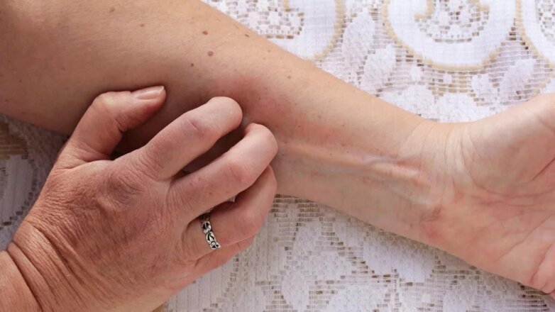 В «странностях» на коже увидели первые признаки рака легких