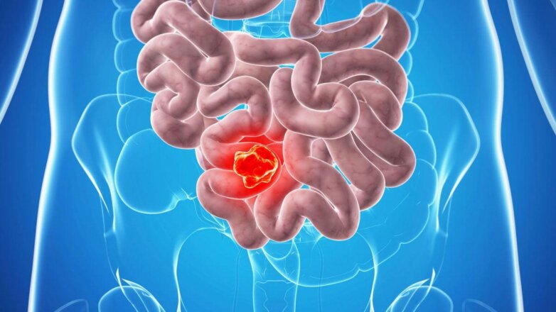 Врачи рассказали о редких признаках рака тонкой кишки