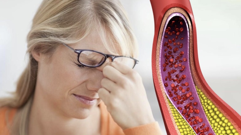 Врачи научили распознавать высокий холестерин по глазам