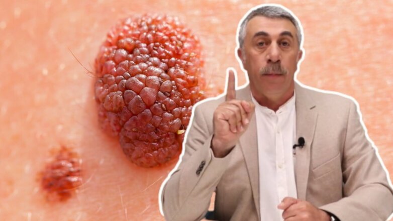 Доктор Комаровский перечислил признаки опасных родинок