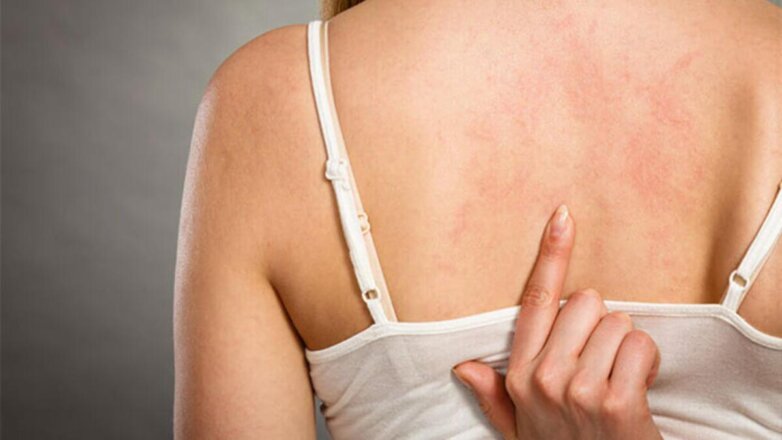 Врачи назвали неожиданную причину появления лопнувших капилляров