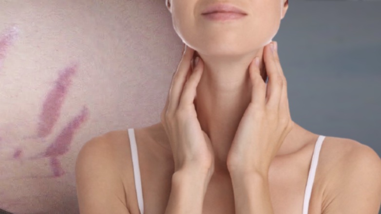 Назван малоизвестный симптом злокачественной опухоли щитовидной железы