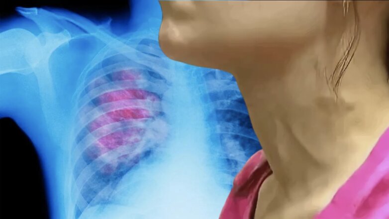 Проблема с венами оказалась признаком злокачественной опухоли