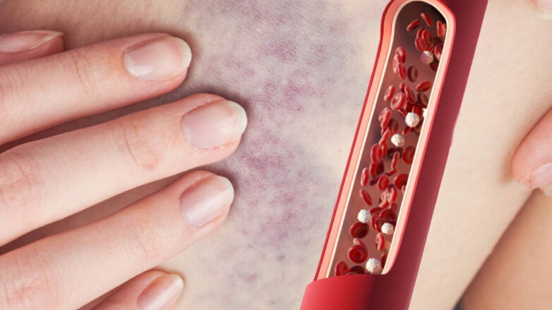 Признаки рака крови назвали врачи