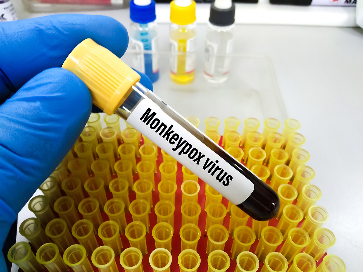 Образец крови, зараженной оспой обезьян, в руках врача для лабораторного анализа.