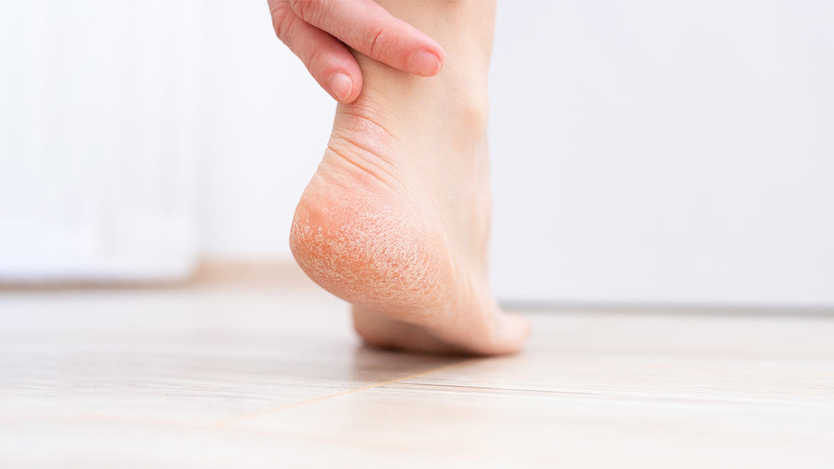 Почему кожа на пятках трескается, и что с этим делать