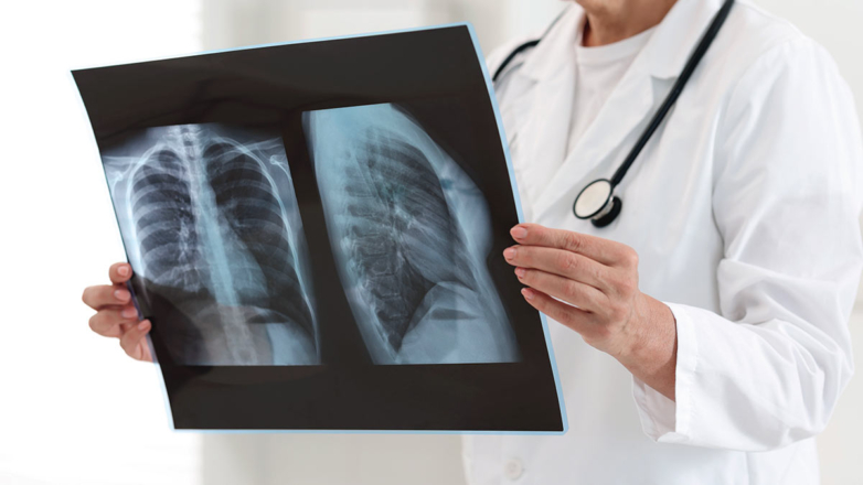 Россия обновила минимум по туберкулезу: 23,9 на 100 тыс.