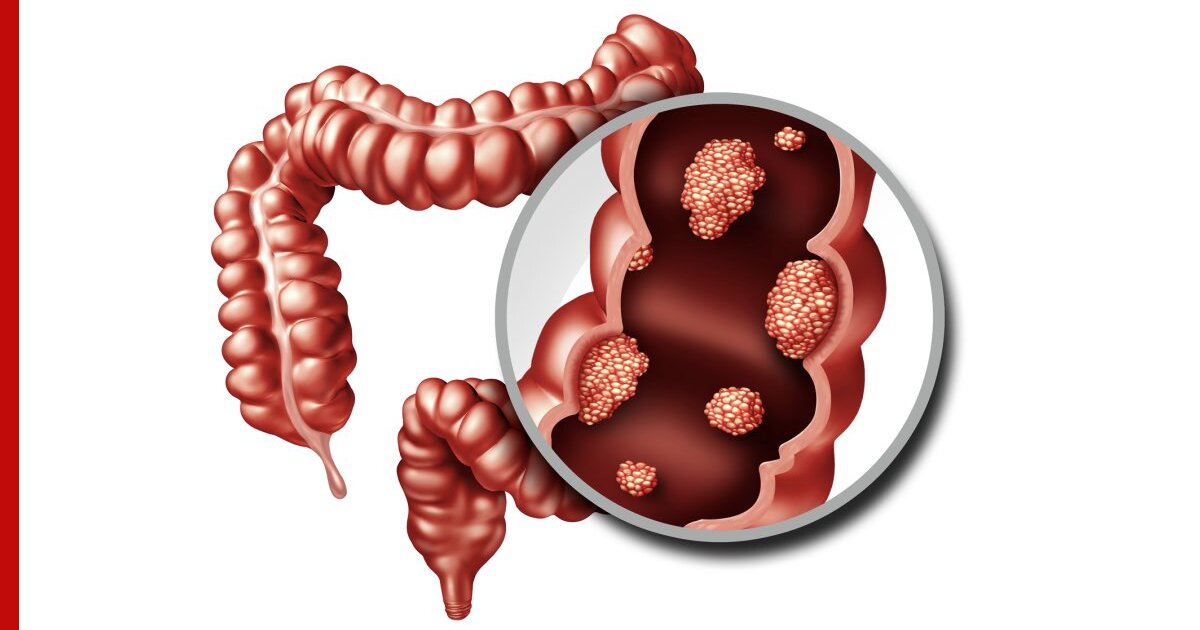 Рак толстой кишки картинки