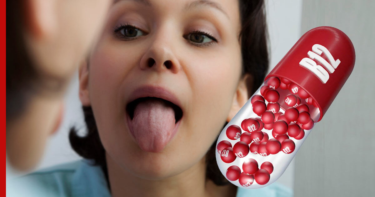 Малокровие недостаток витамина. Дефицит b12 красный язык. Дефицит b12 фото.